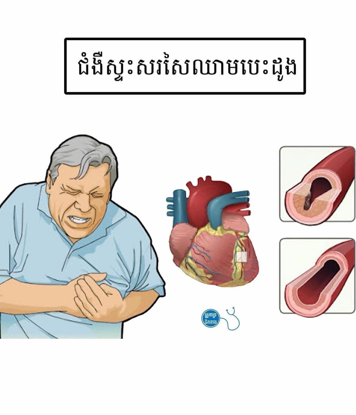 អ្វីជាជំងឺស្ទះសរសៃរឈាមបេះដូង?