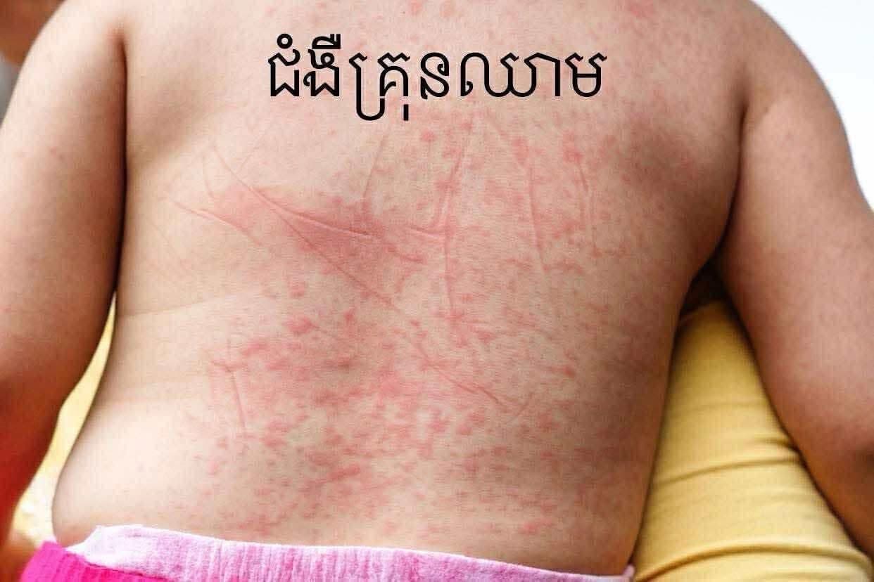 ជំងឺគ្រុនឈាមរដូវវស្សាមកដល់ហើយ ម៉ាក់ប៉ា គួរយល់ដឹងខ្លះៗអំពីអាការ